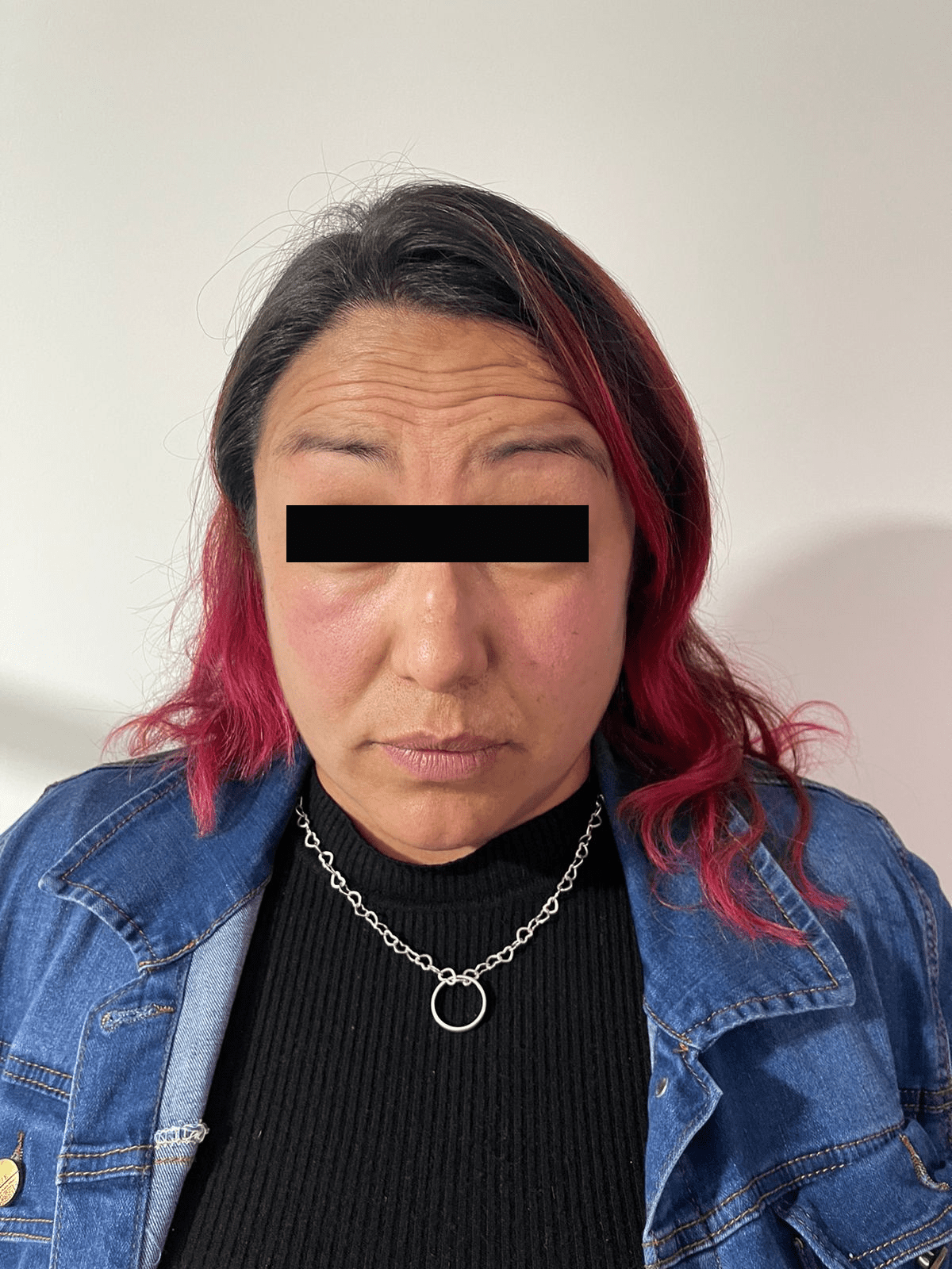 Before-Botox
