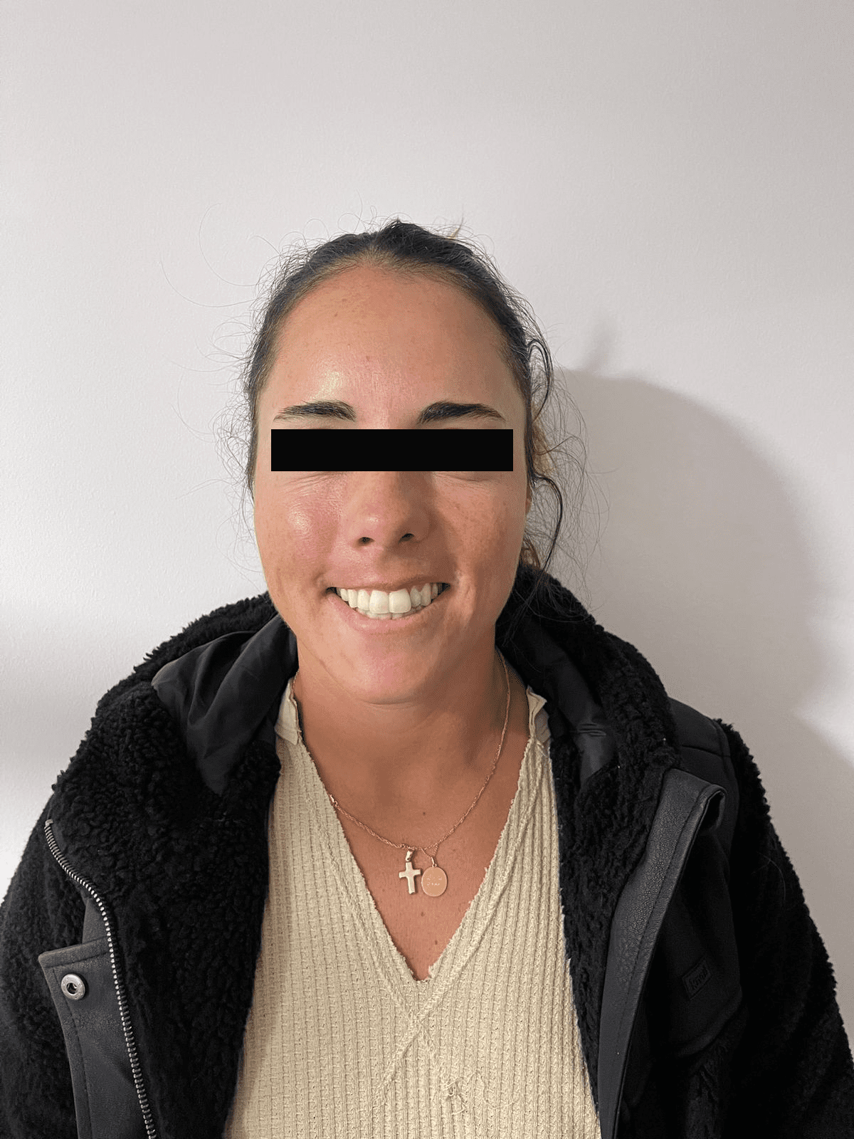 After-Botox